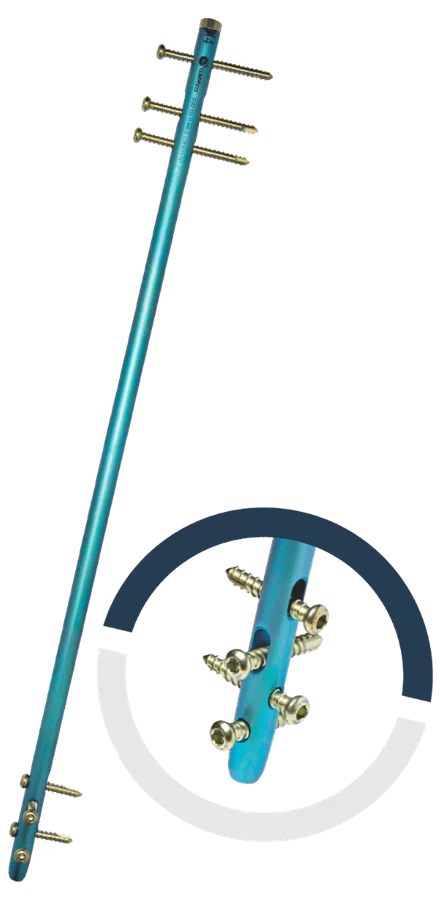 HBFC® — Haste Diafisária de Fêmur