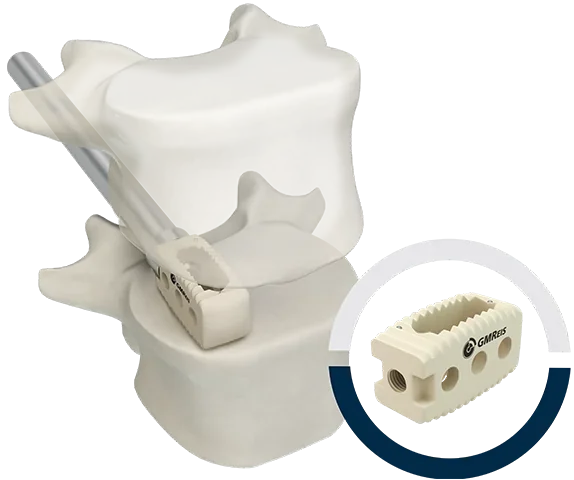 Plifix® PEEK